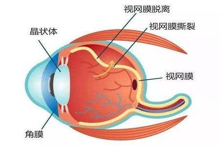 视网膜脱离的原因是什么?中高度近视患者慎做剧烈运动