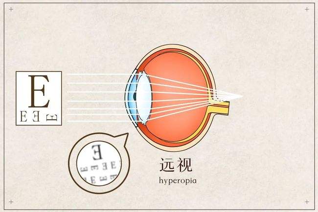 孩子远视，需要配眼镜吗？