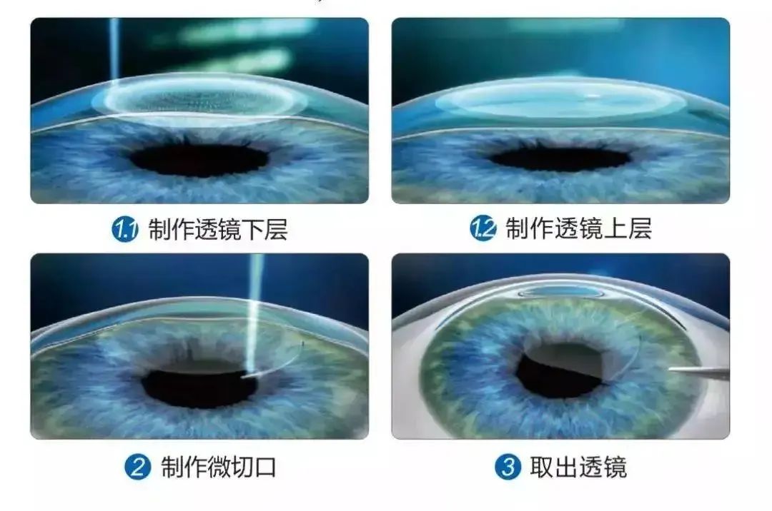 想要做近视手术？要先关注这4个问题