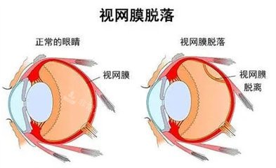 视网膜脱落易发情况