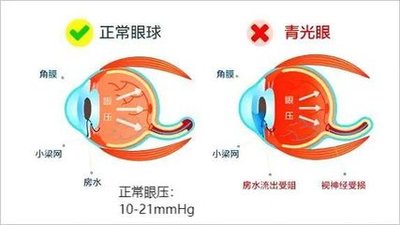 继发性青光眼有哪些病症